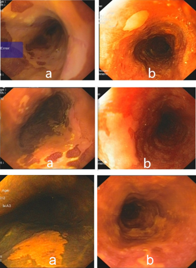 8f44139e67a34cd18cc9379a43ee198d.png 碘染内镜下食管粘膜着色异常样例_副本_副本.png